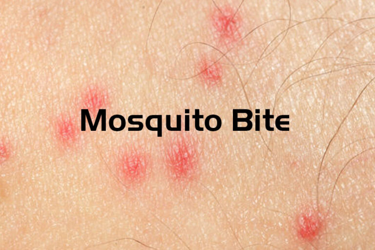 How to Tell the Difference Between Mosquito Bites and Bed Bug Bites