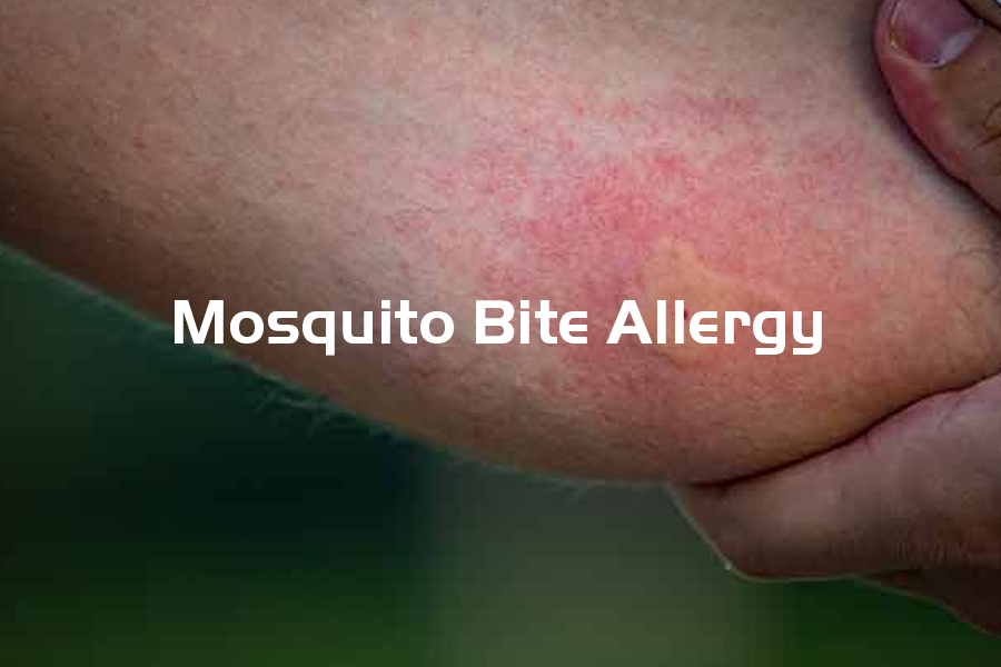 severe reaction to mosquito bites