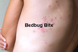 BedBug Bite Symptoms
